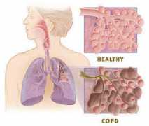 Copd