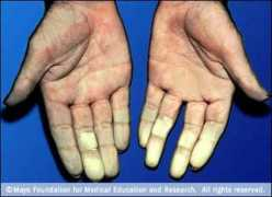 Raynauld