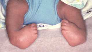Clubfoot