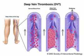 Dvt