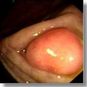 Ileal