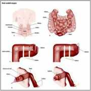 Ileal