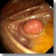 Ileal