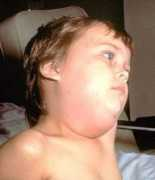 funscrape.com Mumps