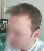 hairlosshelp.com Psin