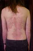 Psoriasis