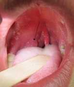 healthhype.com Quinsy