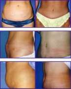lipo.ca Sleightholm