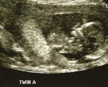 Twina